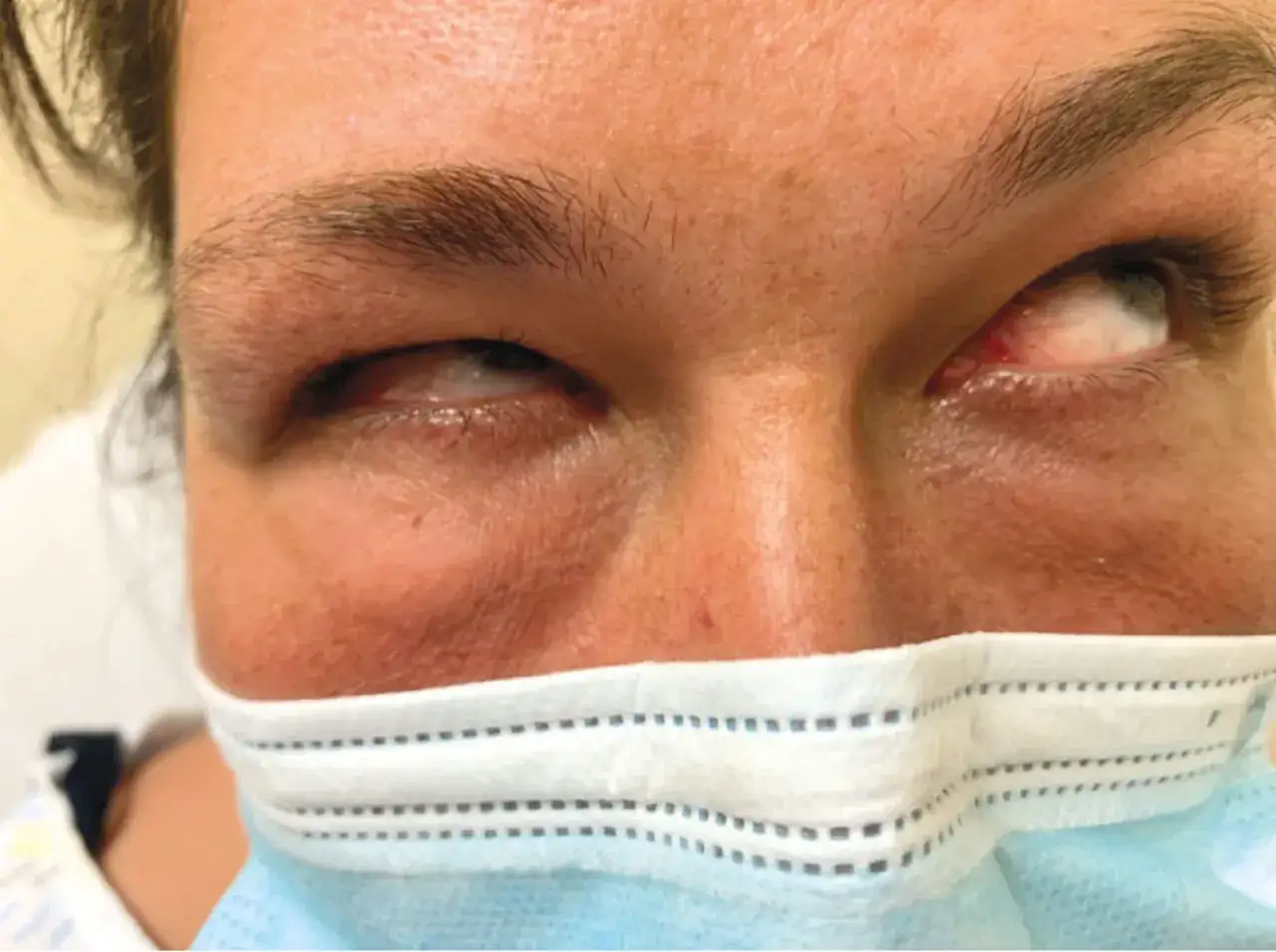 Augen mit abnormaler Bewegung und Rötung, mögliche Symptome eines Vitamin B12-Mangels.