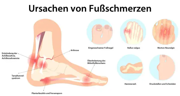 Illustration zeigt Ursachen von Fußschmerzen: Achillessehnenentzündung, Hallux valgus, Morton-Neuralgie, Hammerzeh, Fersensporn und mehr.