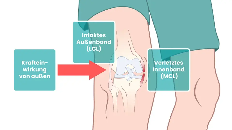 Innenband Knie - Heilung, Behandlung & Reha verstehen